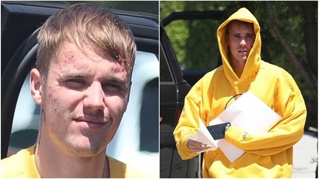 Justin Bieber má zjevn problémy s pletí. Obliej má plná akné!