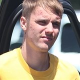 Justin Bieber má zjevně problémy s pletí. Obličej má plná akné!