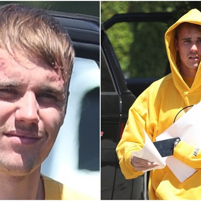 Justin Bieber má zjevně problémy s pletí. Obličej má plná akné!