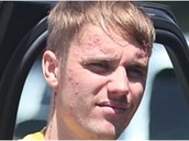 Justin Bieber má zjevn problémy s pletí. Obliej má plná akné!