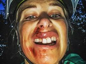 Andrea Sestini Hlaváková mla nehodu na kole. Celá zakrvácená musela vyhledat...