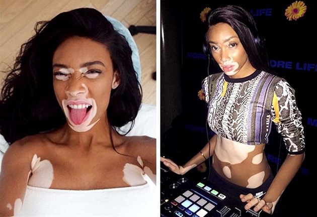 Winnie Harlow