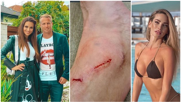 David Limberský ukázal zran�ní ze zápasu. P�ed posm�vá�ky ho chránily man�elka...