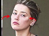 Amber Heard si nechala dle odborníků vpravit do tváří implantáty.