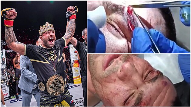 Karlos Vémola se stal králem polotké váhy. Ili ukázal zranní ze zápasu.