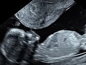 Olga Lounová se pochlubila i fotkou z ultrazvuku. Holka nebo kluk?