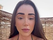 Veronica Biasol odtajnila, �e trpí nemocí vitiligo.