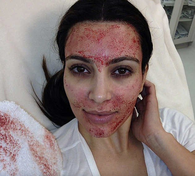 Kim Kardashian po zákroku Vampire Facial