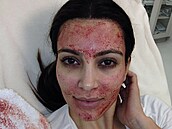 Kim Kardashian po zákroku Vampire Facial