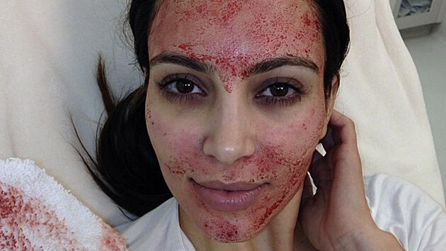 Kim Kardashian po zákroku Vampire Facial