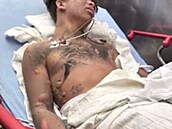 Mason Dark se lé�í s popáleninami