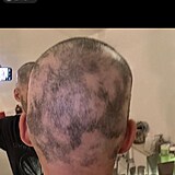 Jordan Haj ukzal, do jakho stdia se jeho alopecie dostala.