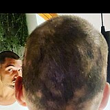 Jordan Haj ukzal, do jakho stdia se jeho alopecie dostala.