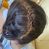 Denisa ukázala svoji hlavu po operaci, která proběhla 1. února 2023.
