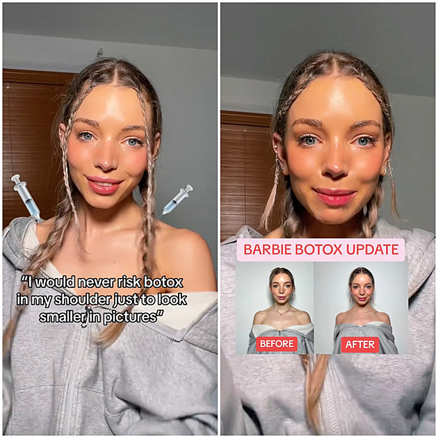 Jak mít stejně štíhlý dekolt jako Barbie? Stačí si nechat do ramenou aplikovat 80 dávek botoxu