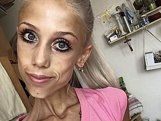 Natálie Hricová sdílela na sítích boj s anorexií