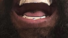 Kanye West a jeho nov� zuby