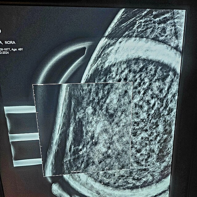 Nora Fridrichov ukzala snmek z mamografu.