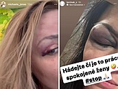 Zran�ní v obli�eji, která si ob� �eny m�ly odnést z plesu.