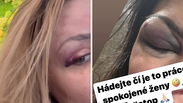 Zran�n� v obli�eji, kter� si ob� �eny m�ly odn�st z plesu.