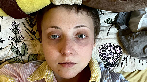 Anna Slováková sdílela fotku po chemoterapii