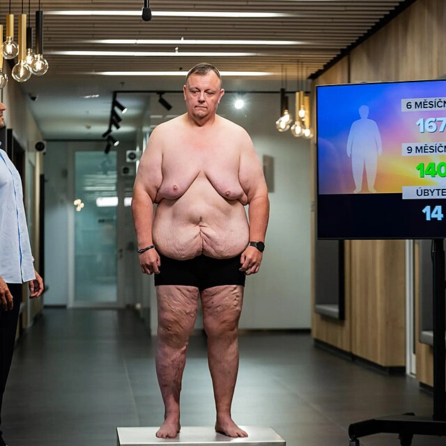 Tom� Mu�ka za rok shodil neuv��iteln�ch 102 kilogram�. Kv�li tomu te� ale m� spoustu p�ebyte�n� k��e.