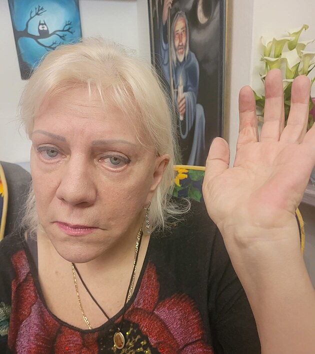 Zp�va�ka ukazuje ruku, na kter� j� l�ka�i odstranili n�dor. M�sto z�kroku je...