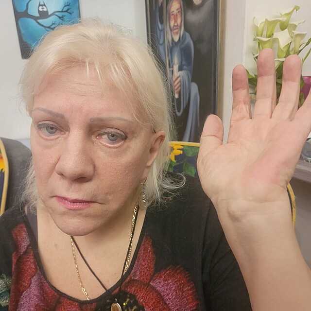 Zp�va�ka ukazuje ruku, na kter� j� l�ka�i odstranili n�dor. M�sto z�kroku je st�le citliv� a znateln� otekl�.