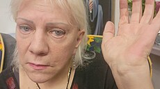 Zp�va�ka ukazuje ruku, na které jí léka�i odstranili nádor. Místo zákroku je...