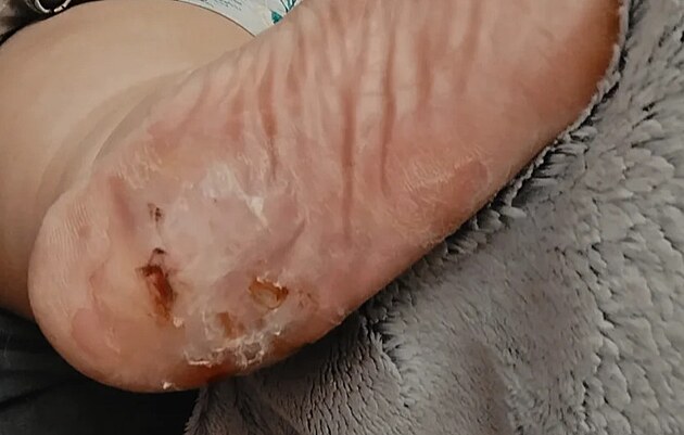 Marie uk�zala svou diabetickou nohu. V po�adu zazn�lo, �e m� strach z amptuace.