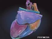 Lékai oivili deset let mrtvé srdce dvanáctileté pacientce, implantát vyjmuli.