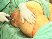 Operace liposukce není vhodná pro obézní eny.