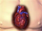 Úmrtnost na infarkt se stále pohybuje kolem 25 %.