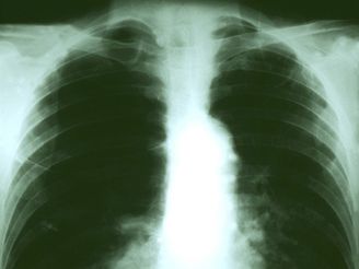 Pasaér z USA ml podle léka nejnebezpenjí formu tuberkulózy. Ilustraní foto