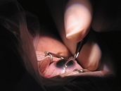 Operace oka (ilustraní foto)