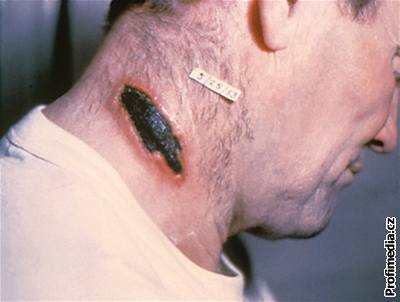 Boláky jsou hlavním symptomem kožního antraxu.
