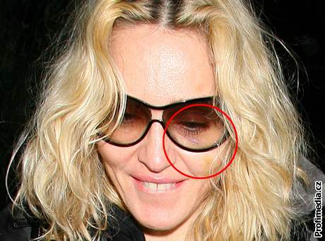 Madonnu vyfotili s modinami kolem oí, které se snaila v ulicích Londýna maskovat sluneními brýlemi