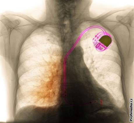 Kardiostimulátor v lidském tle pomáhá udret srdení rytmus