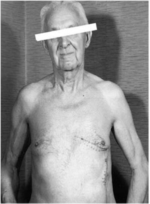 Patient with Greatbatchs pacemaker