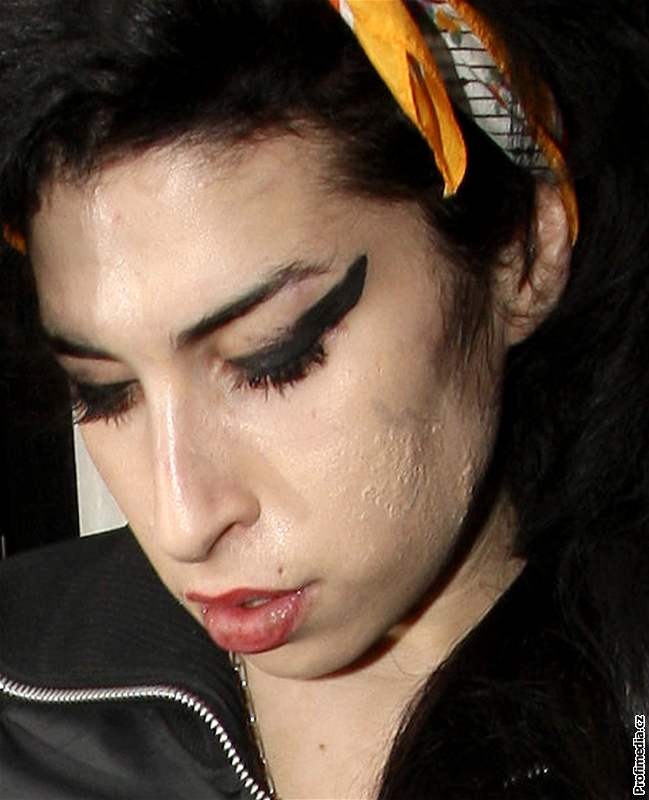 Léka u zpvaky Amy Winehouse diagnostikoval zánt zpsobený stafylokoky a streptokoky. (3.3.2008)