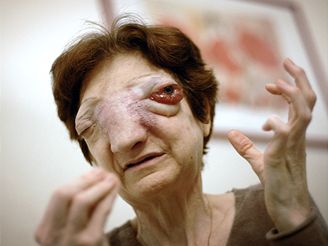 svájci eutanázia anti aging