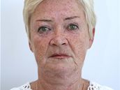 Paní Jitka se rozhodla pro facelifting obli�eje