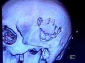 Snímek z magnetické rezonance hlavy Petra echa po zlomenin lebení kosti