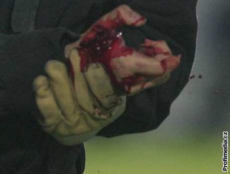 Patnáctiletý chlapec piel o prsty pi neekané explozi taskaviny. Ilustraní foto