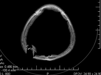 Snmek z tomografu, na nm je vidt zlomen leben kost