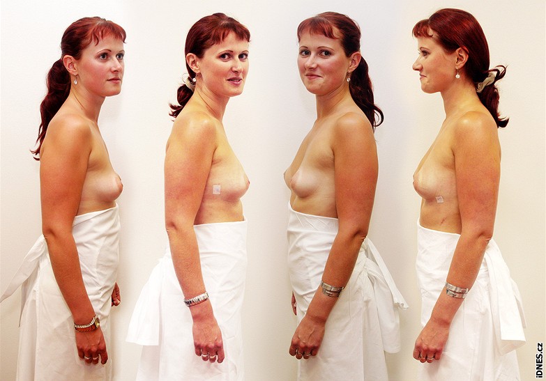 Oldika ped a po (s náplastí) operaci prsou, oba profily - tvar se viditeln zlepil