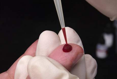 Odebírání krve pro test na HIV pozitivitu
