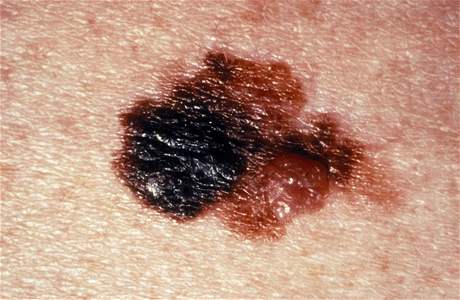 Nejvtí riziko rozvoje dalího typu rakoviny se projevilo u pacient s melanomem.