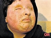 Íránka Amáni Bahramí po popálení kyselinou.