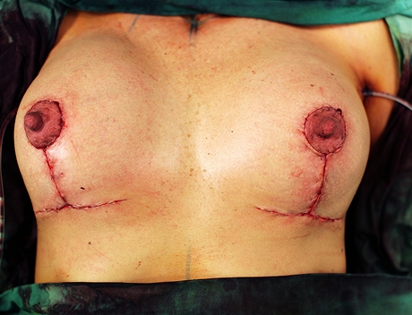 Tsn po zkroku - vmna implantt a modelace prsou